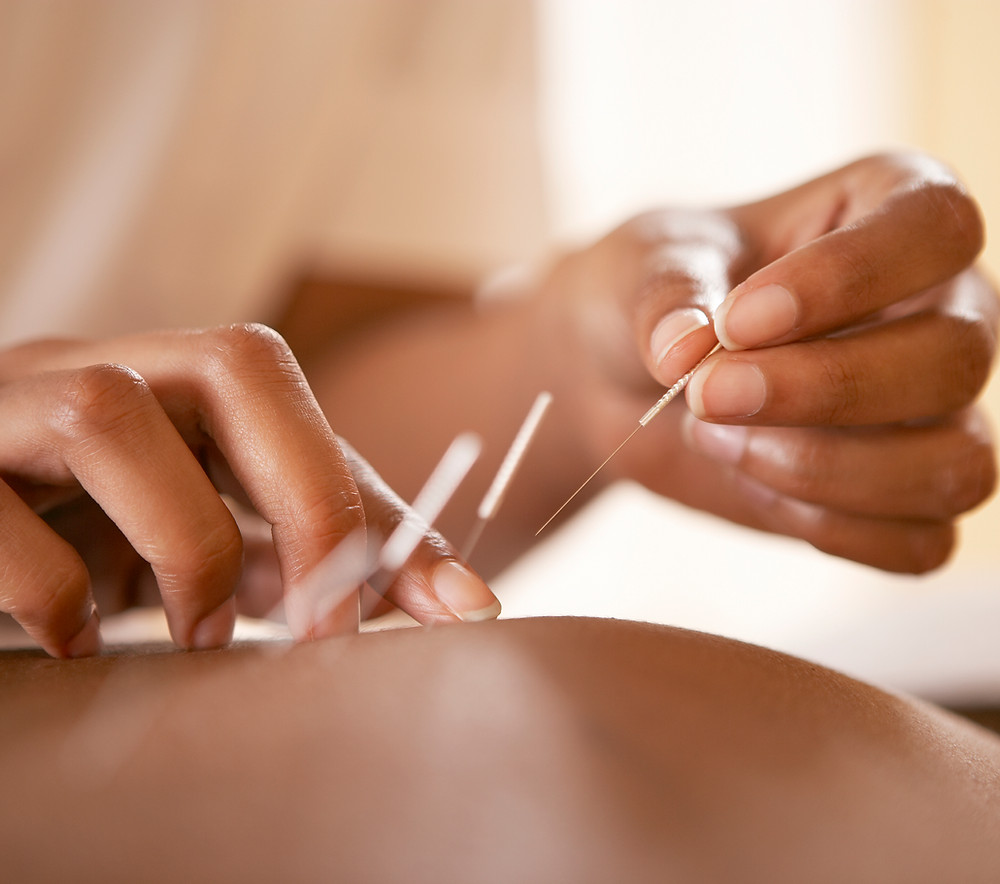 Acupuncture treatment session